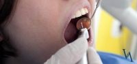 Placa Bacteriana